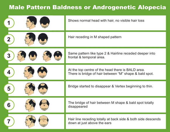 Male Pattern Baldness | Dr Aditis Advanced Homeopathy